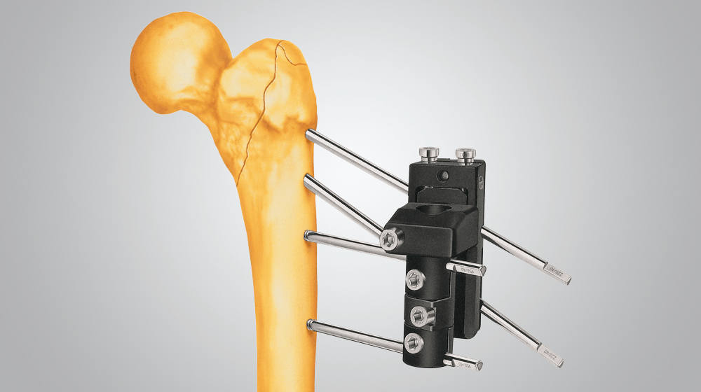 Orthofix Bone Growth Stimulator For Hip